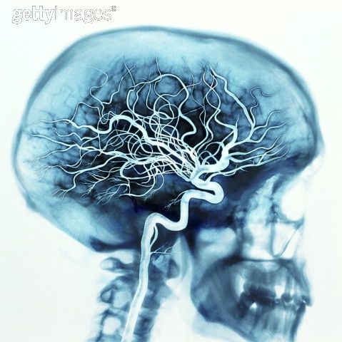 brain-arteries 1.jpg